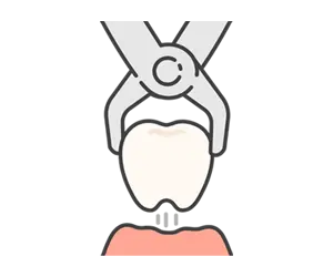 歯を抜かなくてOK