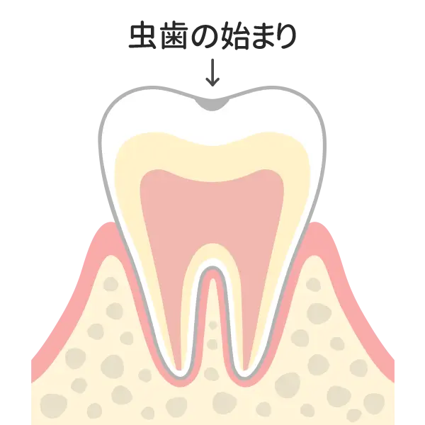 歯の表面の脱灰