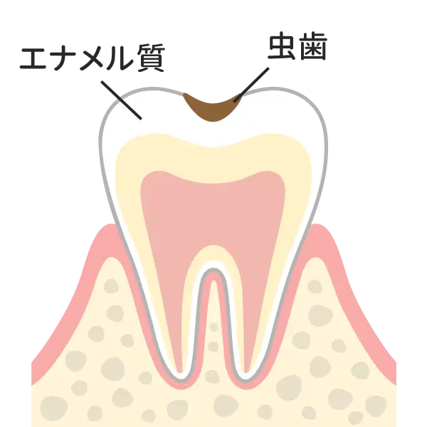 歯の表層（エナメル質）の虫歯