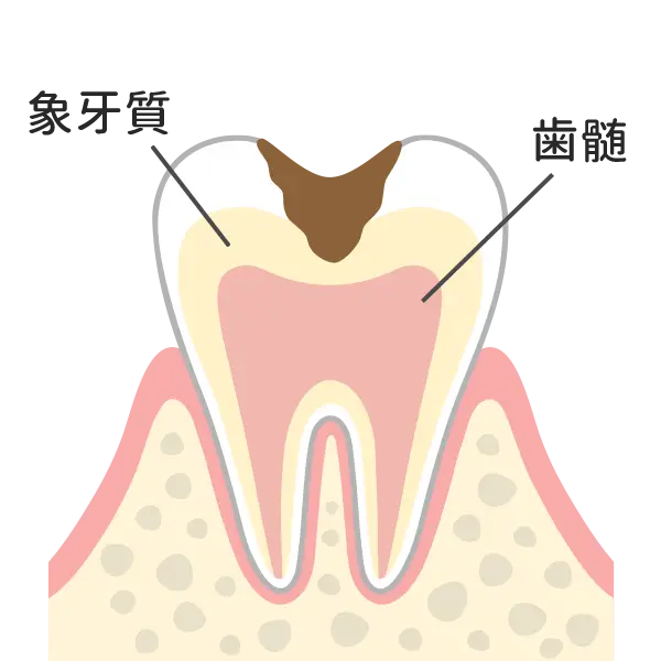 歯の中（象牙質）まで進んだ虫歯