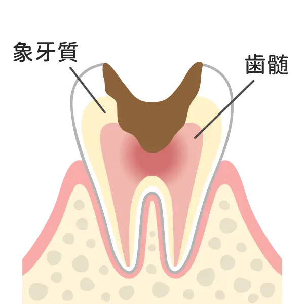 歯の神経まで達した虫歯
