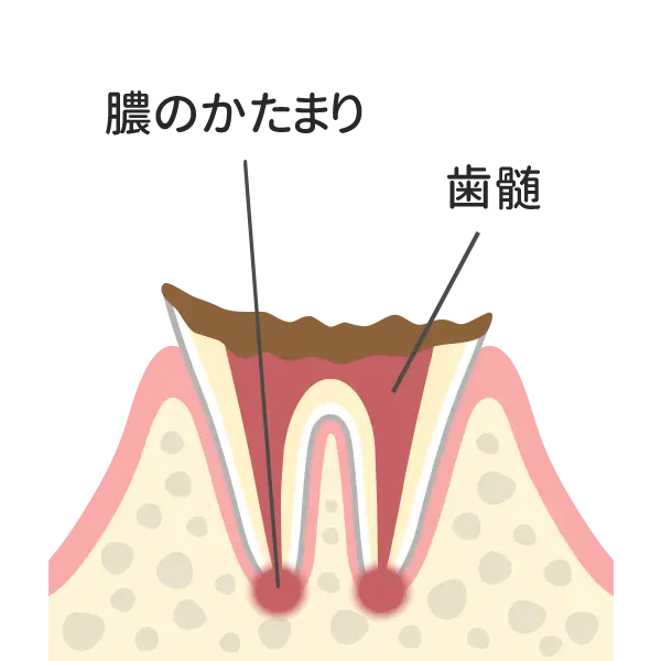 歯の根っこまで達した虫歯