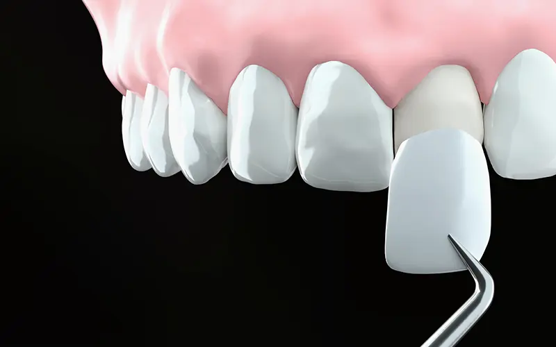 ラミネートベニア