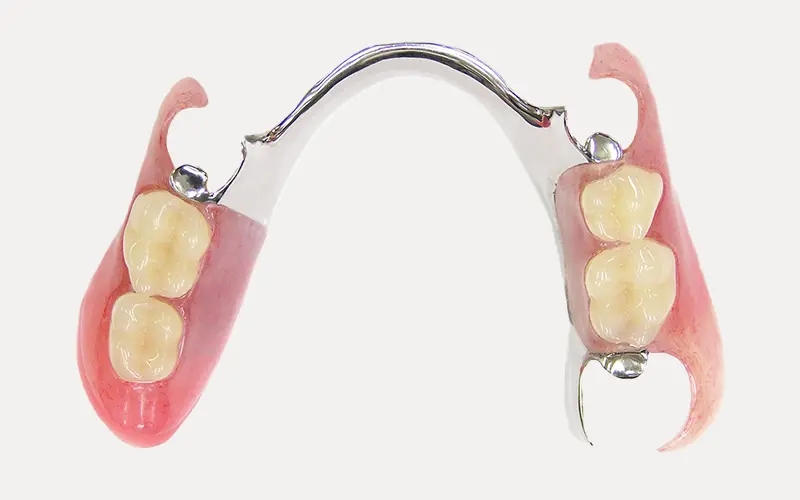 ノンクラスプ金属床義歯