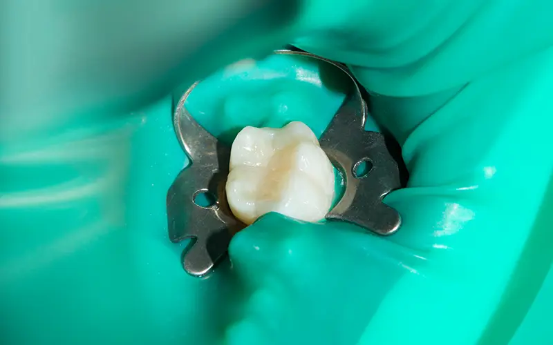 ラバーダム防湿法