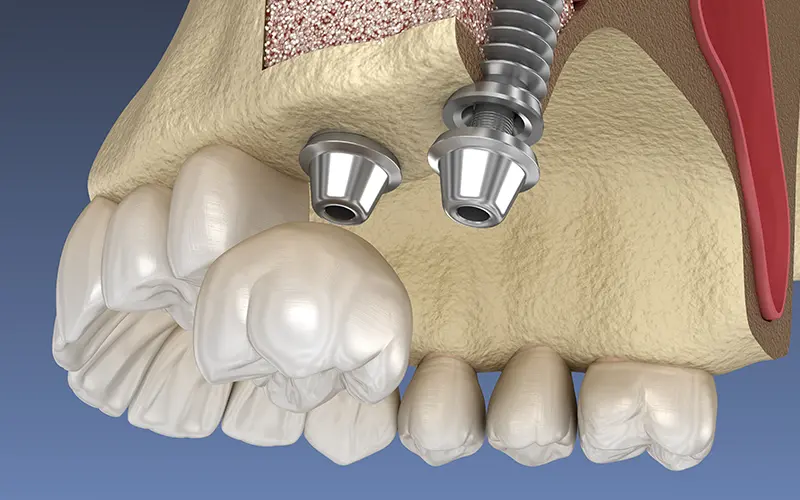 骨造成について