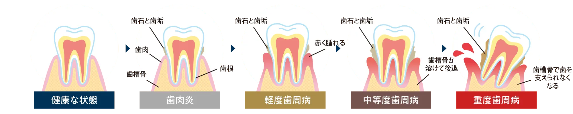 歯周病の進行