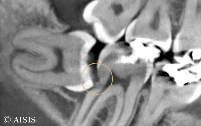 親知らずの抜歯