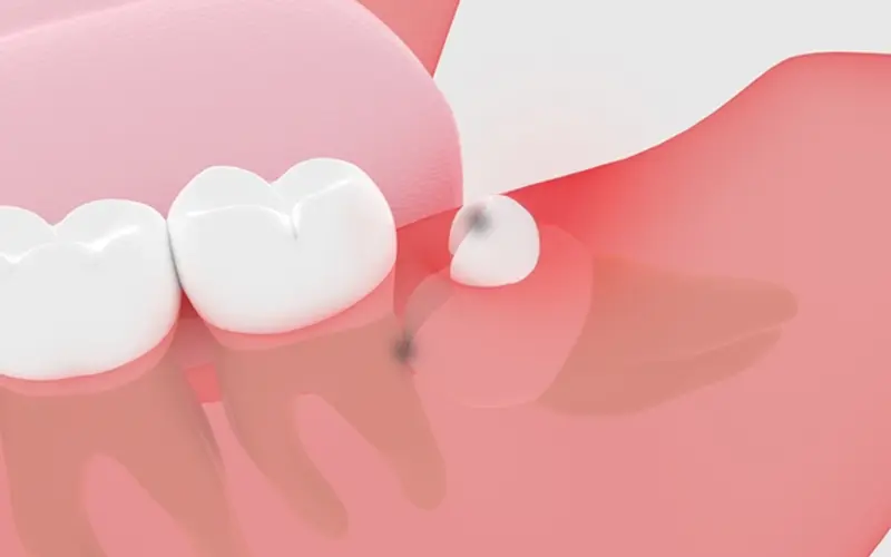 虫歯を引き起こしやすくなる