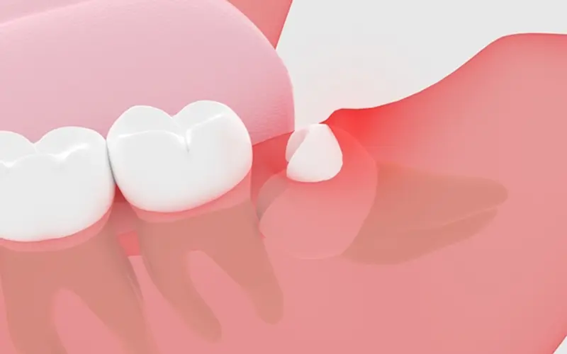 歯周炎を引き起こしやすくなる