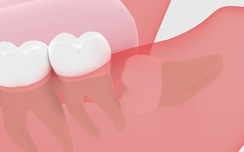 歯並び悪化の可能性がある